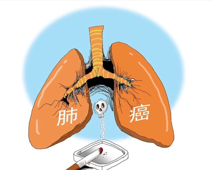 肺癌13.png