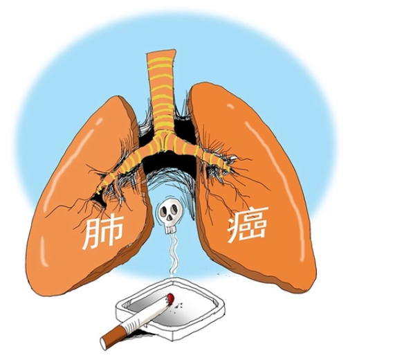 肺癌.png