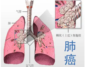 肺癌.png