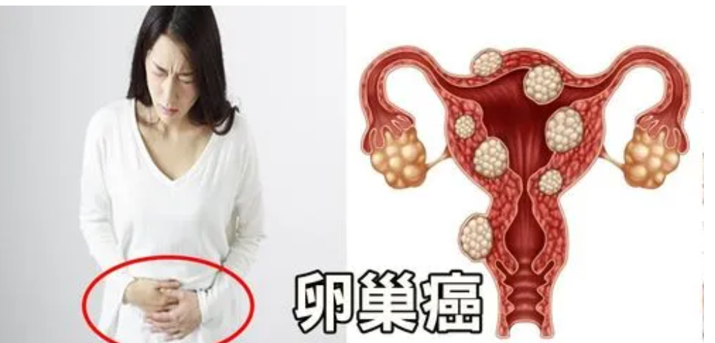 卵巢癌.png