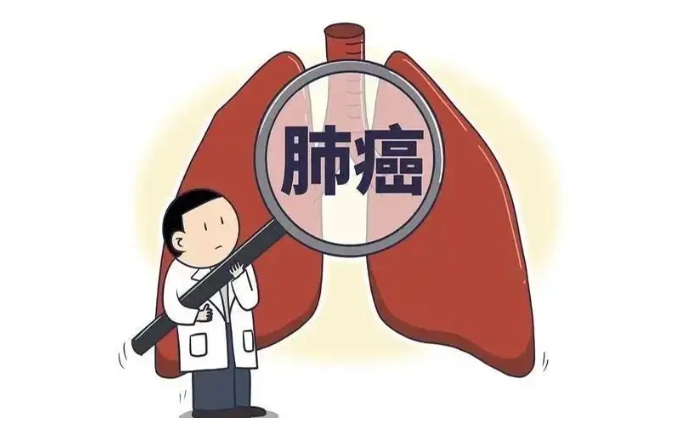 肺癌图片.png