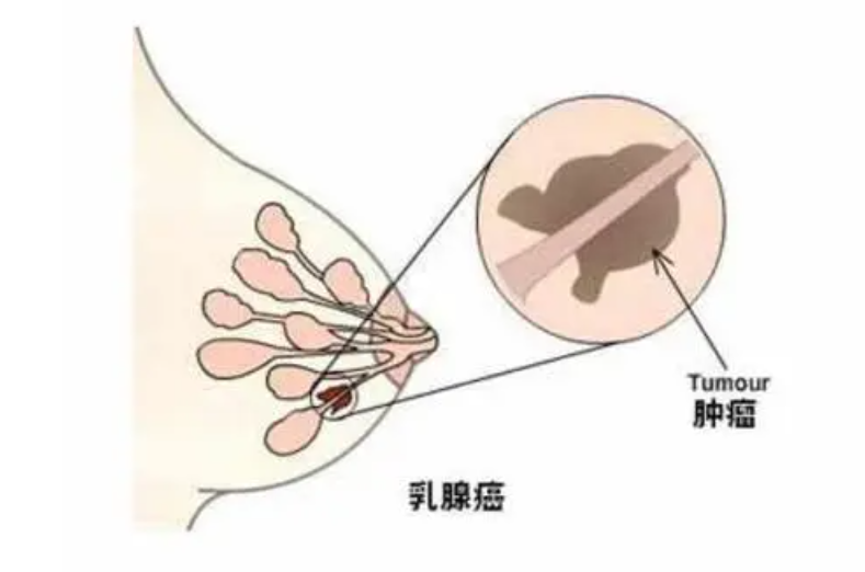 乳腺癌.png