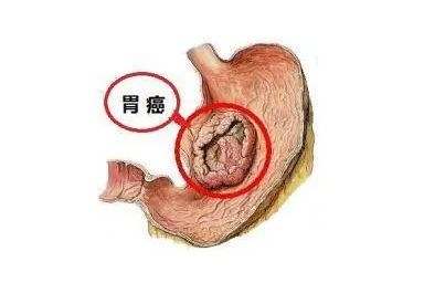 胃癌.png