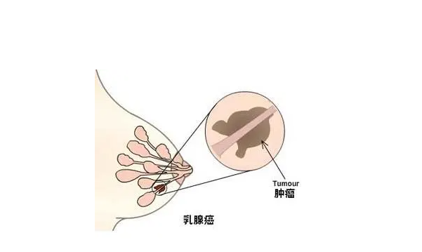 乳腺癌.png