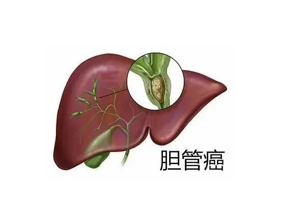 胆管癌.png